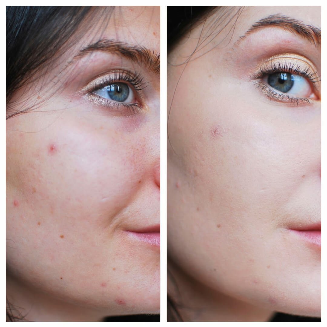 Acne before after