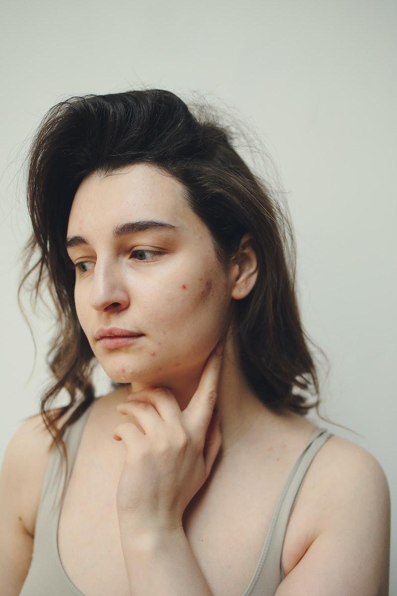 Portrait of a Woman With Acne or purging