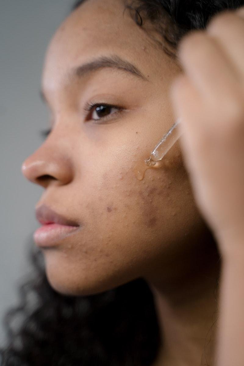 Woman with PIH applying serum to her skin